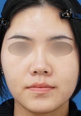 鼻ヒアルロン酸（ボラックス）術後1週間 正面のAfterの写真