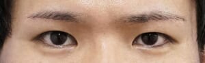 眉下切開3か月後