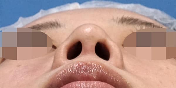 鼻尖縮小・軟骨移植・ストラット　術前　下から