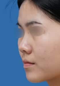 鼻ボラックス 術前 斜め