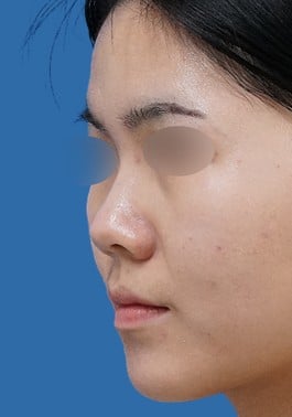 鼻ヒアルロン酸（ボラックス）術後1週間 斜めのBefore写真