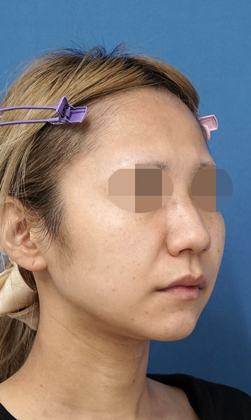 小顔脂肪吸引(ホホ・アゴ下・ほうれい線上) 3ヶ月後 右斜め