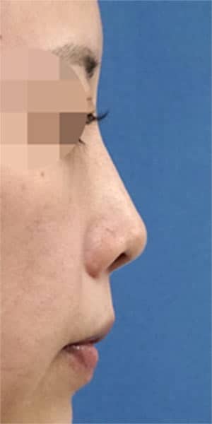 鼻尖縮小・軟骨移植・ストラット　６か月後　右側面のBefore写真