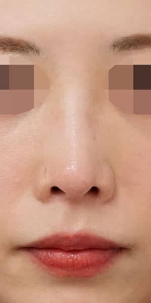 鼻尖縮小・軟骨移植・ストラット　６か月後　正面のAfterの写真
