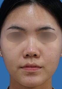 鼻ボラックス 術前 正面