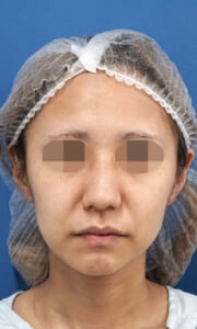 小顔脂肪吸引（ホホ・アゴ下・ほうれい線上）　術前　正面