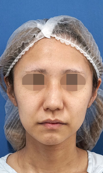 小顔脂肪吸引(ホホ・アゴ下・ほうれい線上) 術前 正面