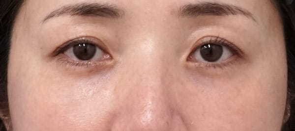 目の下くまとり（目の下脂肪取り＋コンデンス脂肪注入）　6ヶ月後のAfterの写真