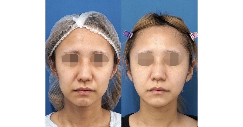 脂肪吸引でたるみをすっきり｜小顔脂肪吸引（ホホ・あご下・ほうれい線上）　３ヶ月後