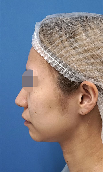 小顔脂肪吸引(ホホ・アゴ下・ほうれい線上) 術前 左側面