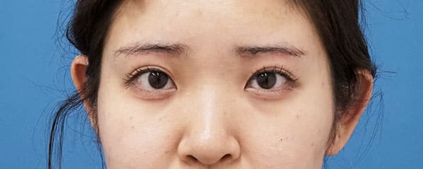 眉下切開　１ヶ月後のAfterの写真