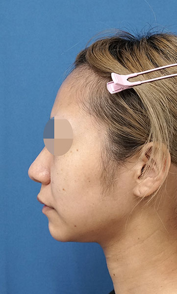 小顔脂肪吸引(ホホ・アゴ下・ほうれい線上) 3ヶ月後 左側面