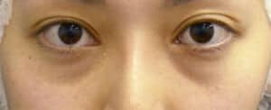 目の下の脂肪取りだけ行った症例（術後目の下の凹みが目立った症例）　手術前