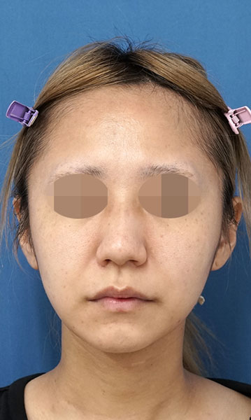 小顔脂肪吸引(ホホ・アゴ下・ほうれい線上) 3ヶ月後 正面