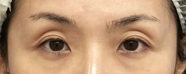 切らない眼瞼下垂プレミアム＋目頭切開Z形成　６ヶ月後のBefore写真