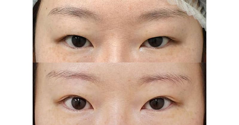 たるみのあるまぶたの二重を広く・厚みすっきり・目を大きく・間延び感も減らす｜眉下切開６ヶ月後