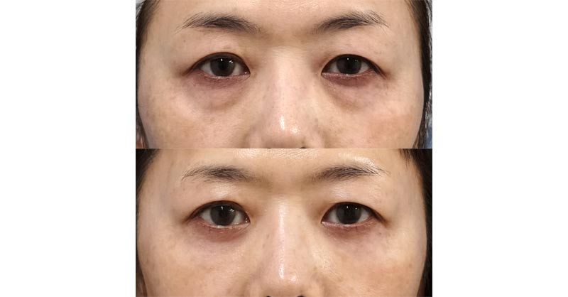 目の下脂肪取り・脂肪注入でくまとり　７ヶ月後