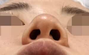 鼻尖縮小、小鼻縮小（内側＋外側）　手術前　下から