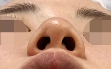 鼻尖縮小・小鼻縮小（内側＋外側）　６ヶ月後　下からのBefore写真