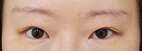 眉下切開　６ヶ月後