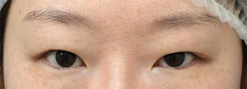 眉下切開　手術前
