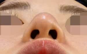 鼻尖縮小、小鼻縮小（内側＋外側）　手術前　下から