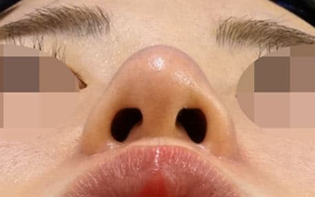 鼻尖縮小・小鼻縮小（内側＋外側）　６ヶ月後　下からのAfterの写真