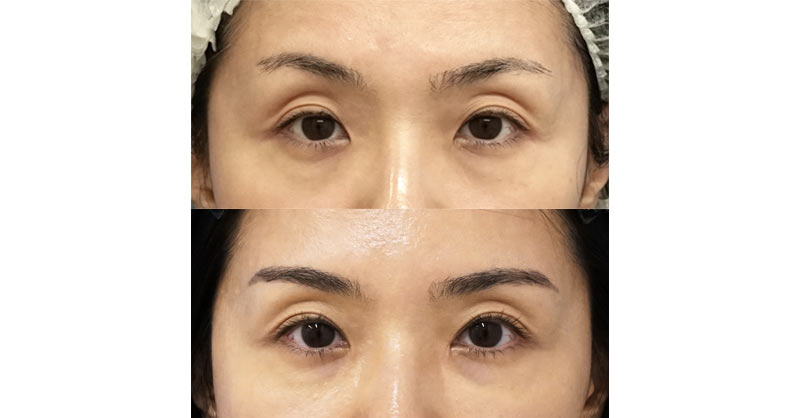 目を若々しく華やかに｜切らない眼瞼下垂プレミアム＋目頭切開Z形成　６ヶ月後