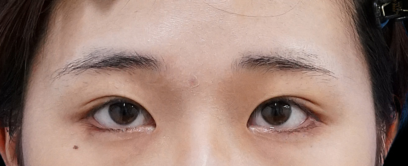 切らない眼瞼下垂プレミアム×切らないタレ目　術後1週間のAfterの写真