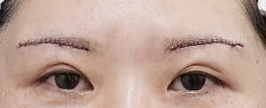 眉下切開術直後