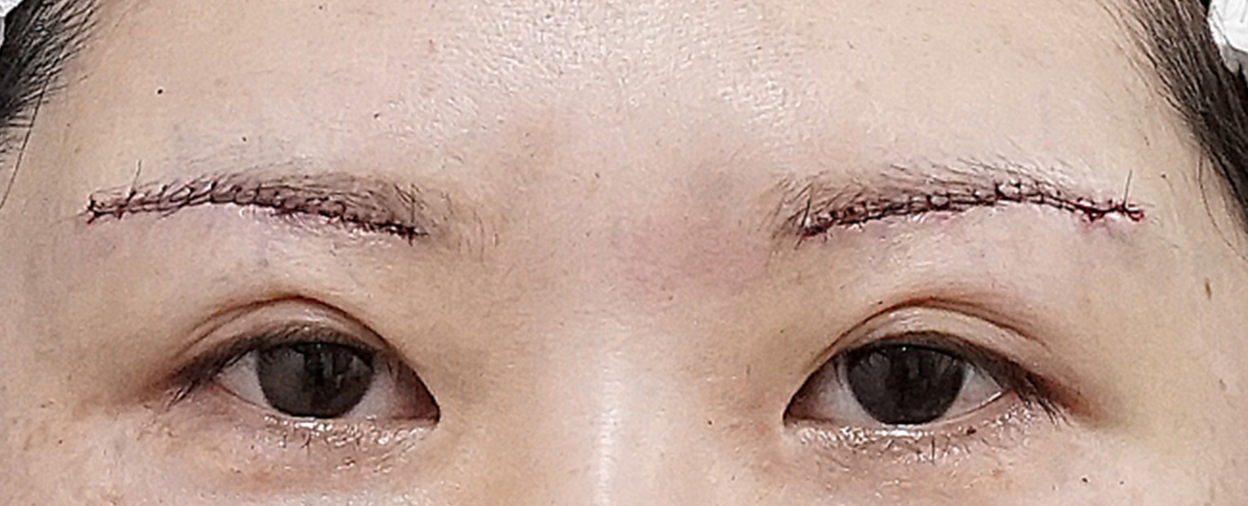 眉下切開 術直後のAfterの写真