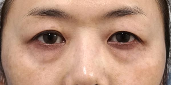 目の下脂肪取り・コンデンス脂肪注入　７ヶ月後のBefore写真