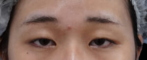 切らない眼瞼下垂プレミアム・タレ目 術前