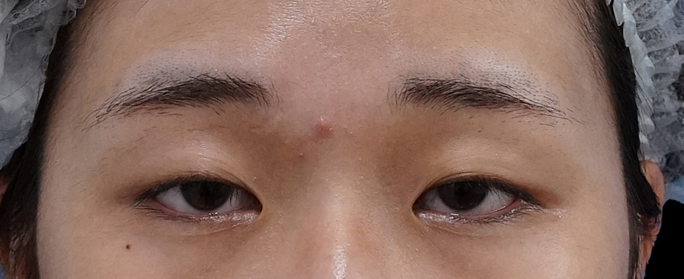 切らない眼瞼下垂プレミアム×切らないタレ目　術後3か月のBefore写真