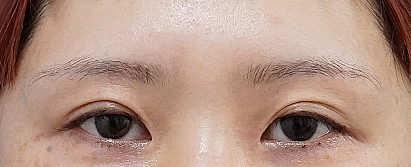 眉下切開 術後6か月のAfterの写真