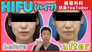 HIFU（ハイフ）の効果が出るまでの期間と小顔効果の持続力はどのくらい？症例写真付きで解説