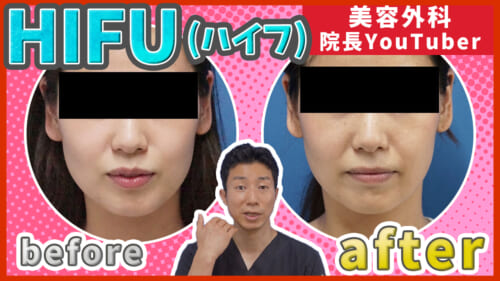 HIFU（ハイフ）効果はどのくらい？症例写真付きで解説