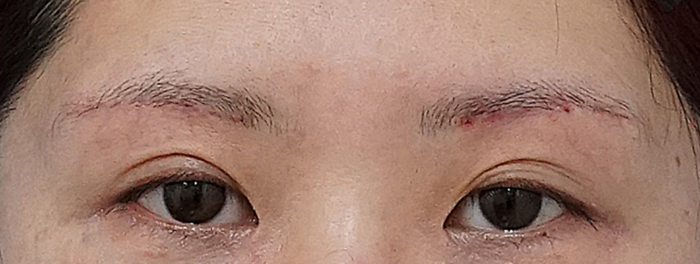 眉下切開 術後3か月のAfterの写真