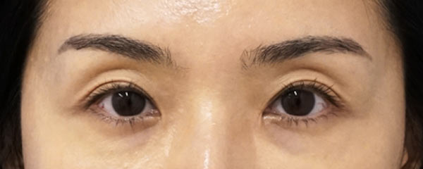 切らない眼瞼下垂プレミアム＋目頭切開Z形成　６ヶ月後のAfterの写真