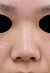 鼻尖縮小＋軟骨移植＋ストラット、鼻翼縮小（内＋外法）手術前　正面