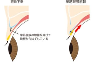 挙筋前転術イメージ