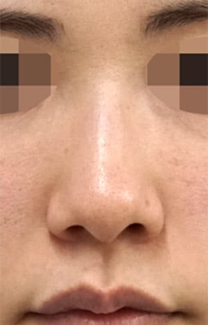 鼻尖縮小・小鼻縮小（内側＋外側）　６ヶ月後　正面のBefore写真