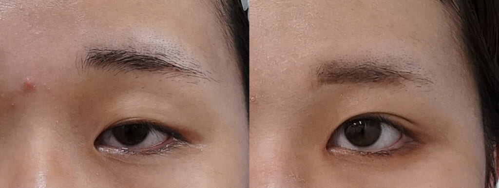 切開せずに整える目元治療｜切らない眼瞼下垂×タレ目形成の変化