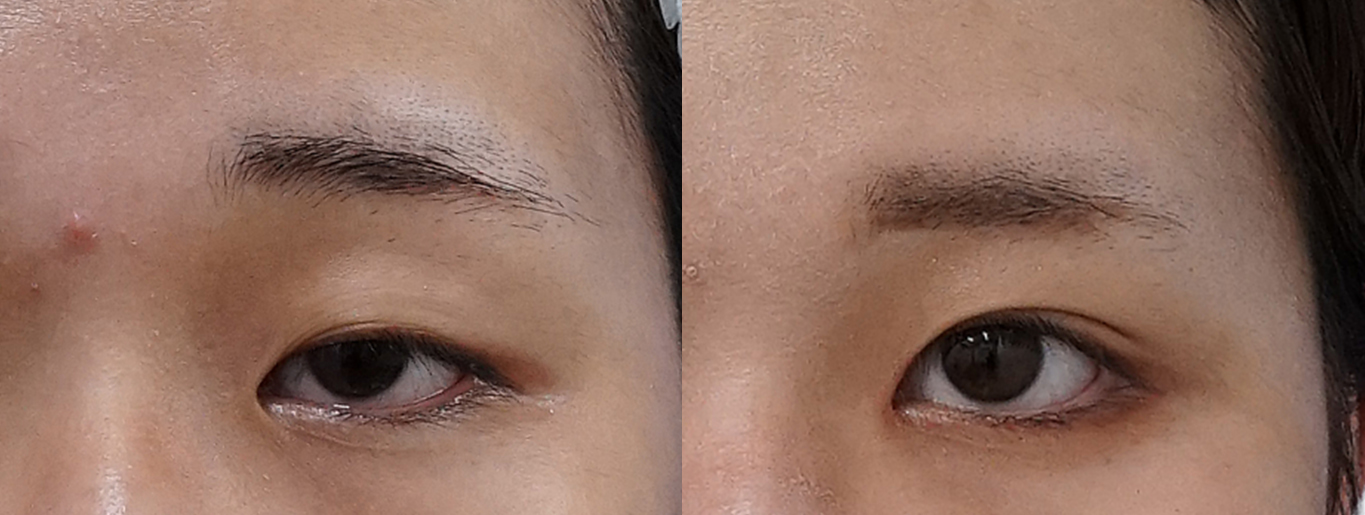 切らない眼瞼下垂プレミアム・タレ目 アイキャッチ