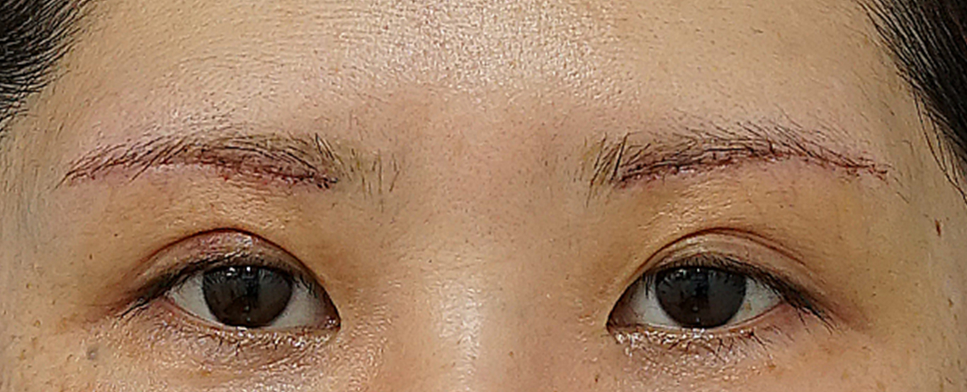 眉下切開 術後5日（抜糸直後）のAfterの写真