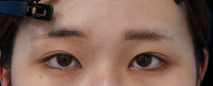 切らない眼瞼下垂プレミアム・タレ目 術後3か月