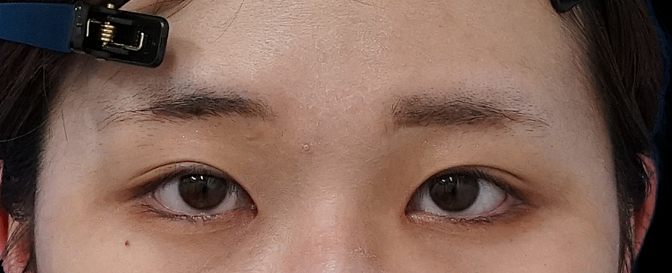 切らない眼瞼下垂プレミアム×切らないタレ目　術後3か月のAfterの写真