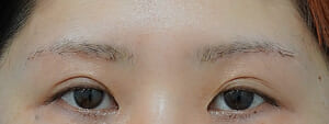 眉下切開術後1か月