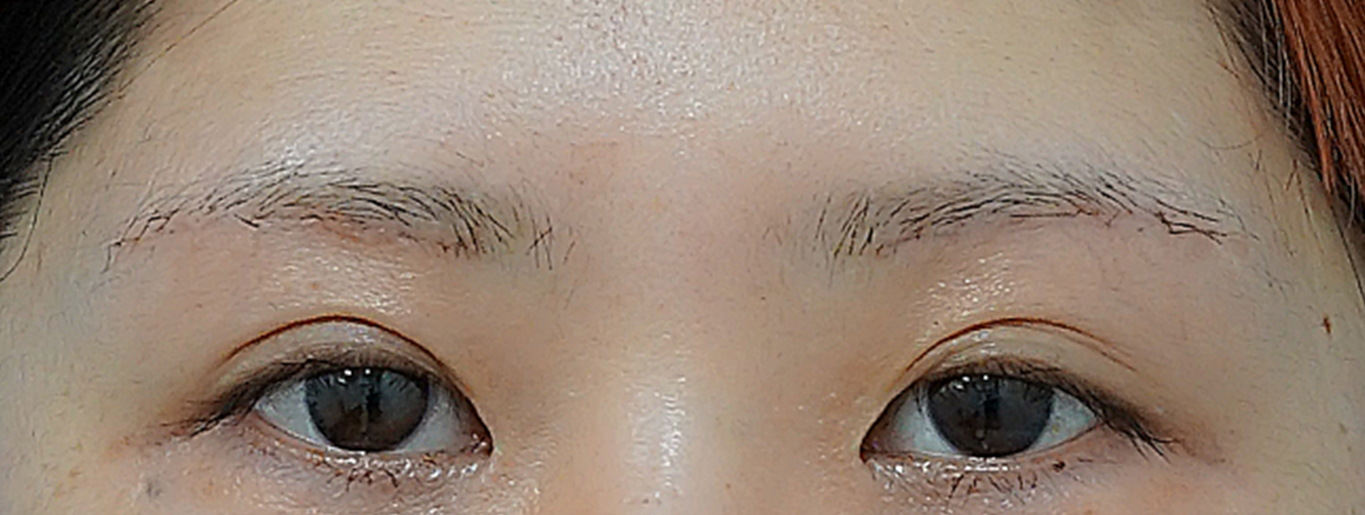 眉下切開 術後1か月のAfterの写真