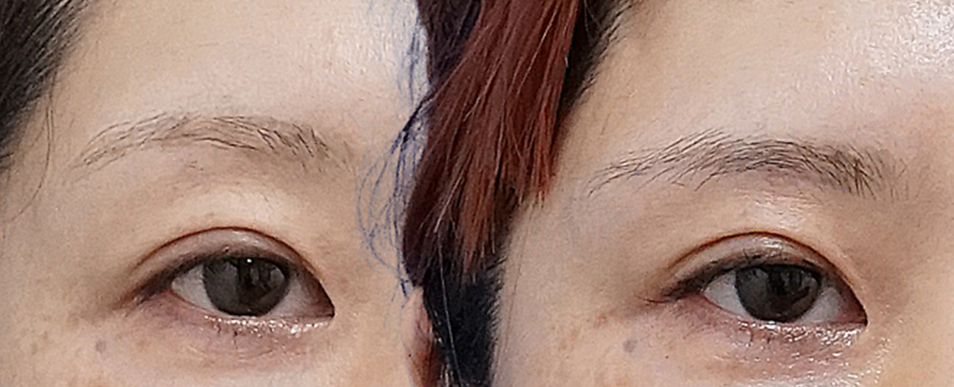 眉下切開アイキャッチ